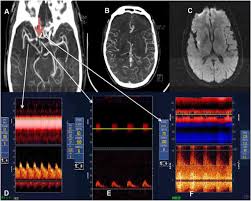 Transcranial Doppler ultrasonography ...