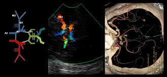 Transcranial Doppler ultrasound ...
